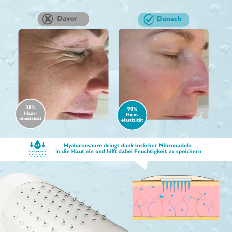 Microneedling GlowPads I Pads mit Mikronadel-Technologie gegen Augenringe und Mimikfalten